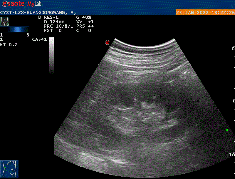 CYST-LZX-HUANGDONGWANG_20220125123704_1322260
