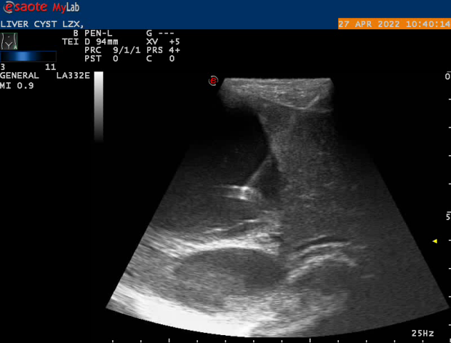 LIVER_CYST_LZX_20220[20220807-002945]