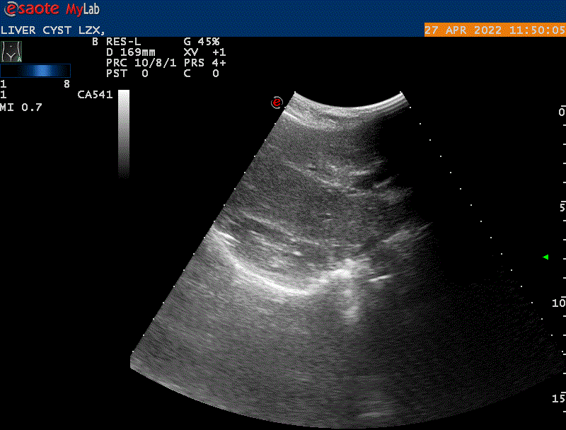 LIVER_CYST_LZX_20220427104218_1150050
